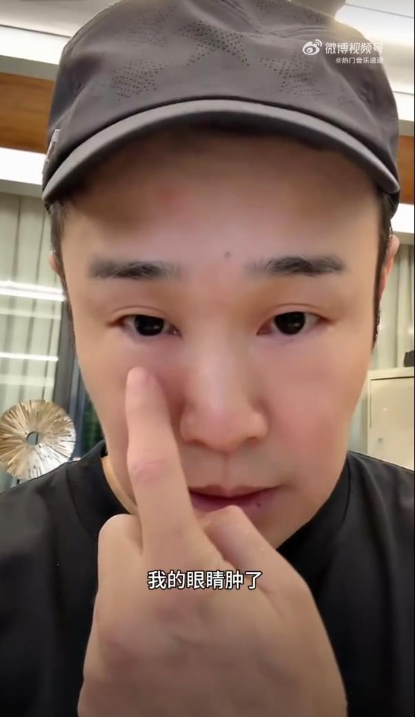 小沈阳公演当天一觉醒来眼睛浮肿:“给大家报备一下,一觉醒来眼睛肿成蜜蜂小狗了”